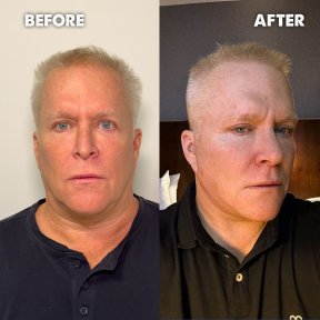 Premium Face&Neck lift + Upper Blephasroplasty+ Fat Transfer to Face Surgery -All Incluisive with European Board Certified Doctor Ali Sadioglu