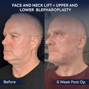 Premium Face&Neck lift + Upper Blephasroplasty+ Fat Transfer to Face Surgery -All Incluisive with European Board Certified Doctor Ali Sadioglu - photo 3