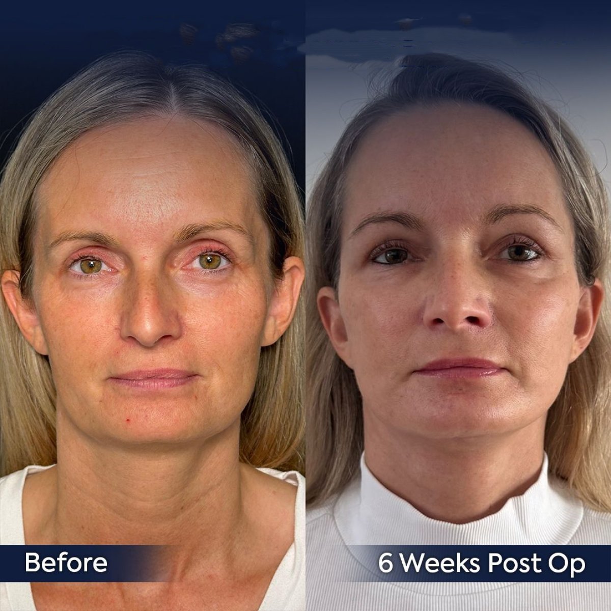 Facelift before and after results at Dr. Safa Manav Clinic, visible facial rejuvenation
