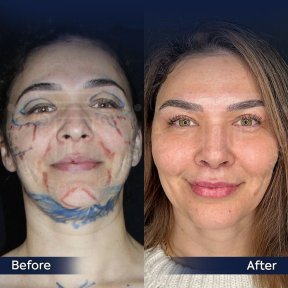 Premium Face&Neck lift + Upper Blephasroplasty+ Fat Transfer to Face Surgery -All Incluisive with European Board Certified Doctor Ali Sadioglu - photo 4