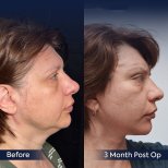 Before and after Facelift photos by Dr. Ali Sadioglu Md