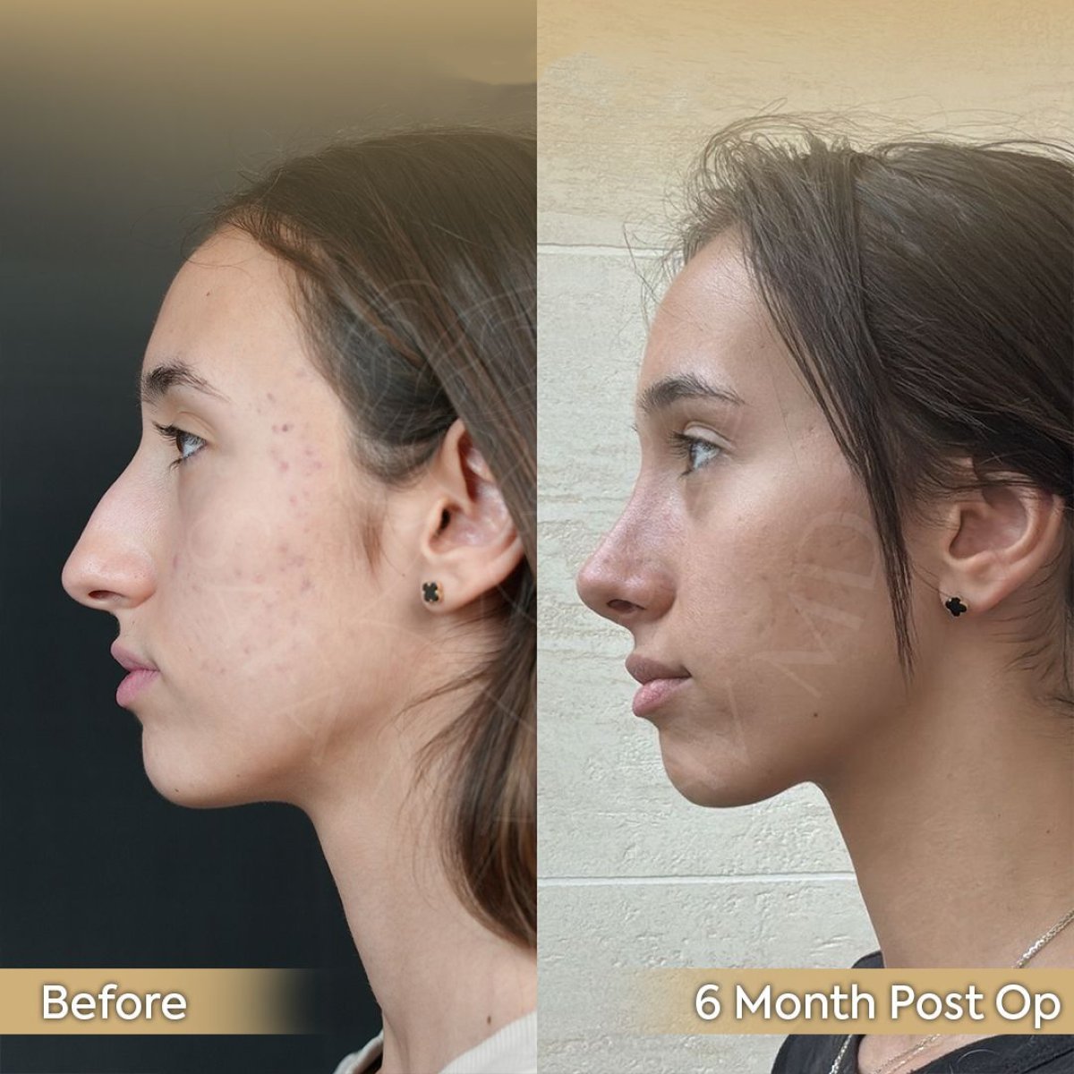 Resultados de rinoplastia antes y después en Dr. Safa Manav Clinic, remodelación nasal tras 6 meses