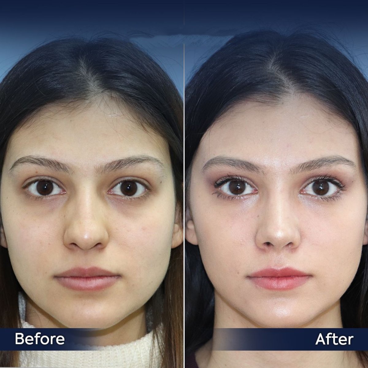 نتائج عملية تجميل الأنف قبل وبعد في عيادة Dr. Safa Manav، تحسين شكل الأنف