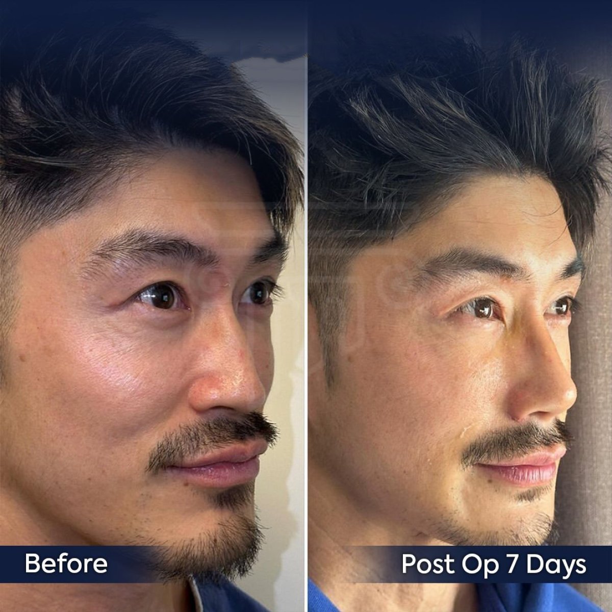 Resultados de rinoplastia antes y después en Dr. Safa Manav Clinic, remodelación en 7 días