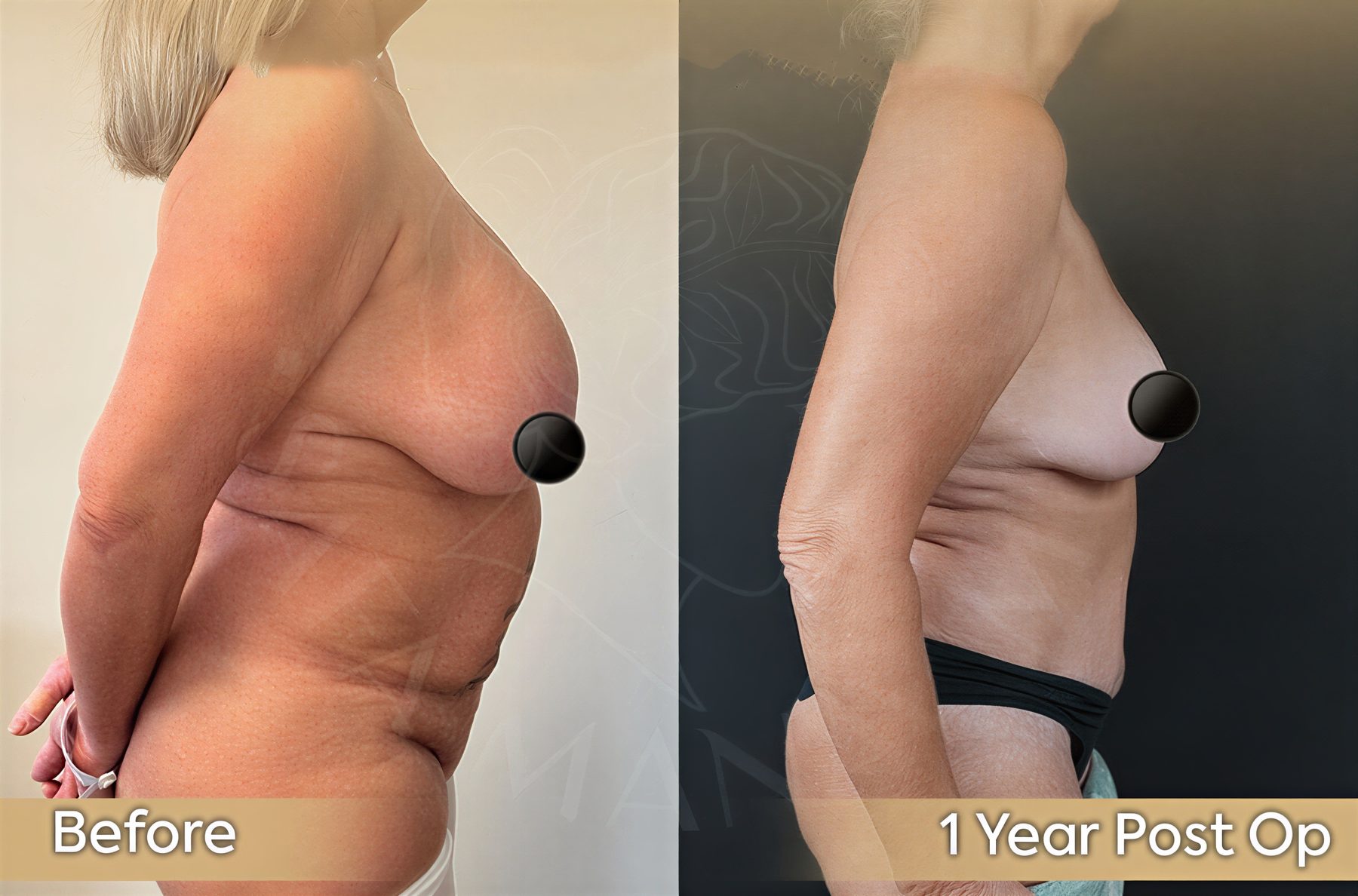 Resultados antes y después de lifting de senos en Dr. Safa Manav Clinic, contorno mejorado