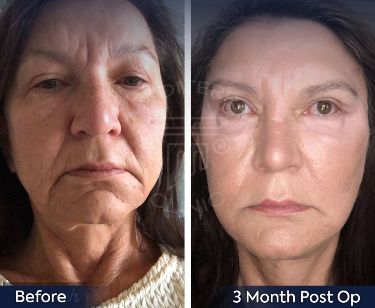 Résultats avant/après lifting des sourcils à la clinique Dr. Safa Manav, rajeunissement visible