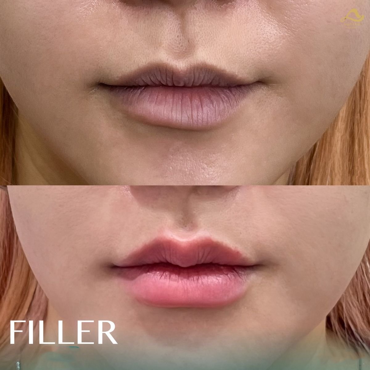 Antes y después de relleno de labios en Anjali Clinic, resultado de volumen y contorno