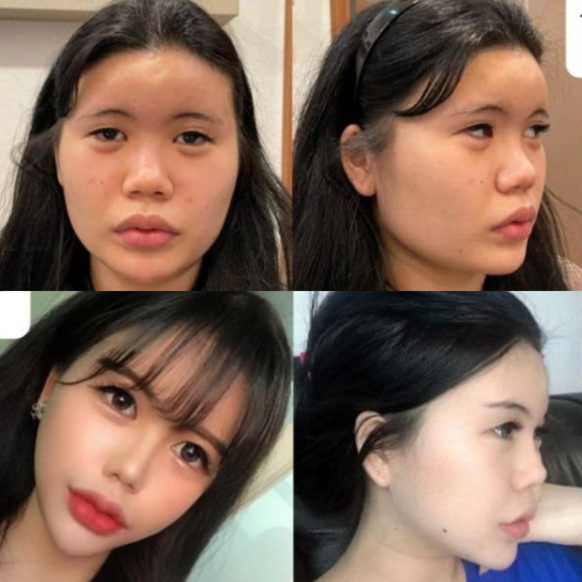 قبل وبعد تصغير عظم الوجنة في VG Plastic Surgery، نتيجة تحديد ملامح الوجه واضحة