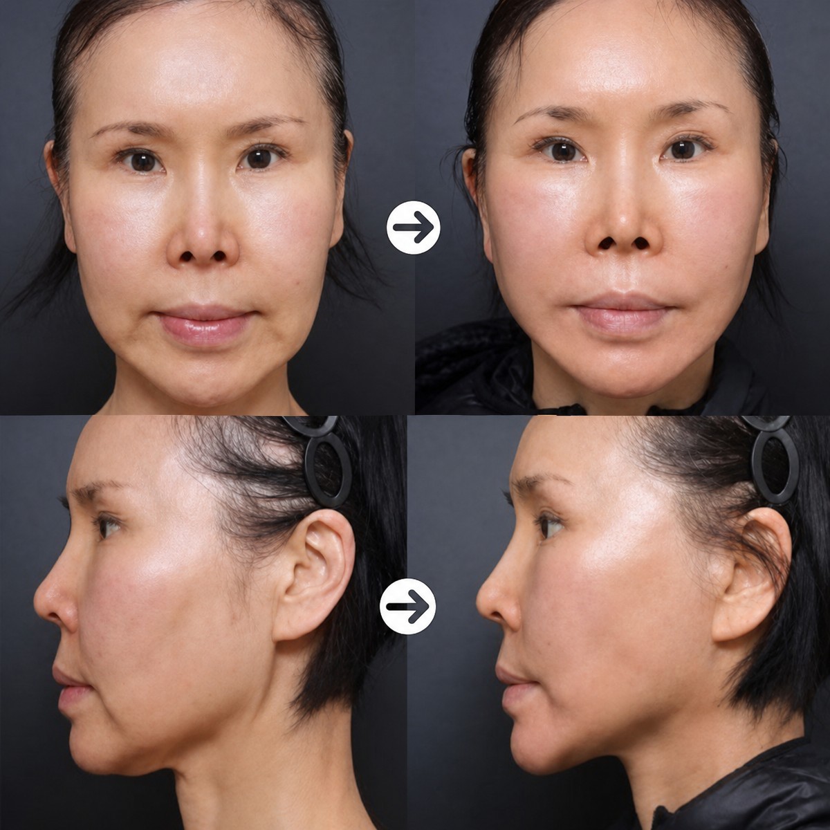 نتائج قبل وبعد تصغير عظم الوجنة في VG Plastic Surgery، تحسين ملامح الوجه