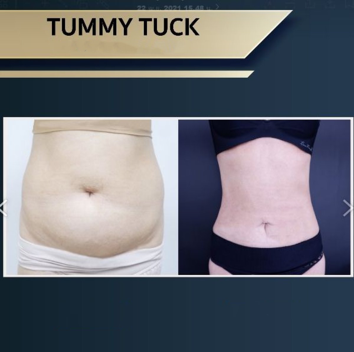 Before and after tummy tuck results at Asia Cosmetic Hospital, visible abdominal contour improvement