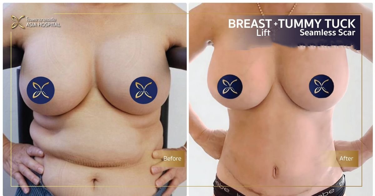 Before and after mommy makeover results at Asia Cosmetic Hospital – breast lift and tummy tuck