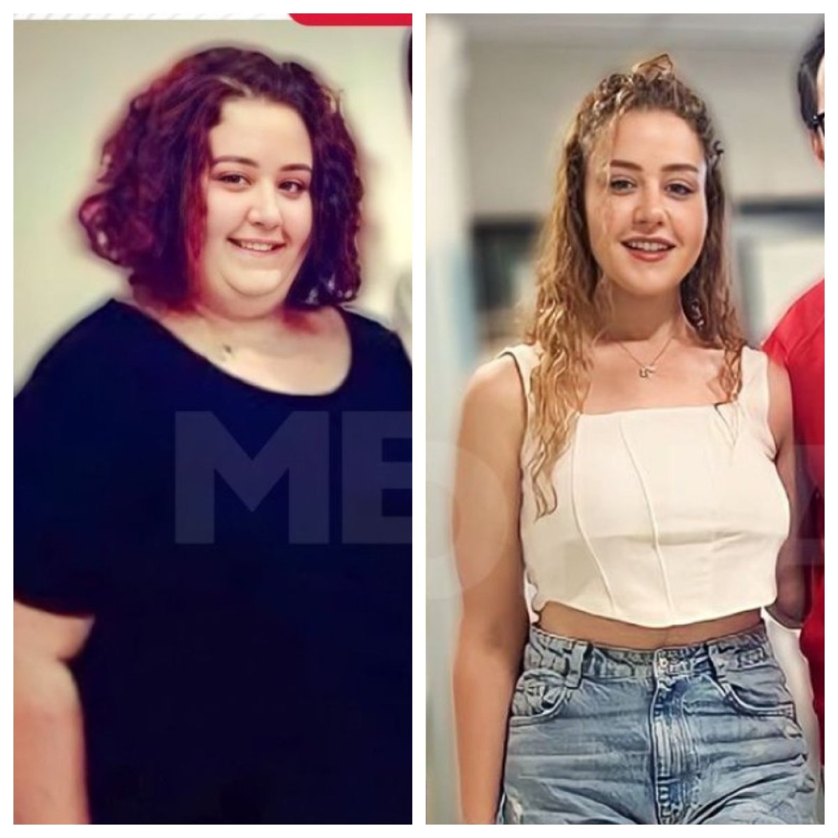 Before and after gastric bypass at Memorial Şişli Hospital, significant weight loss result