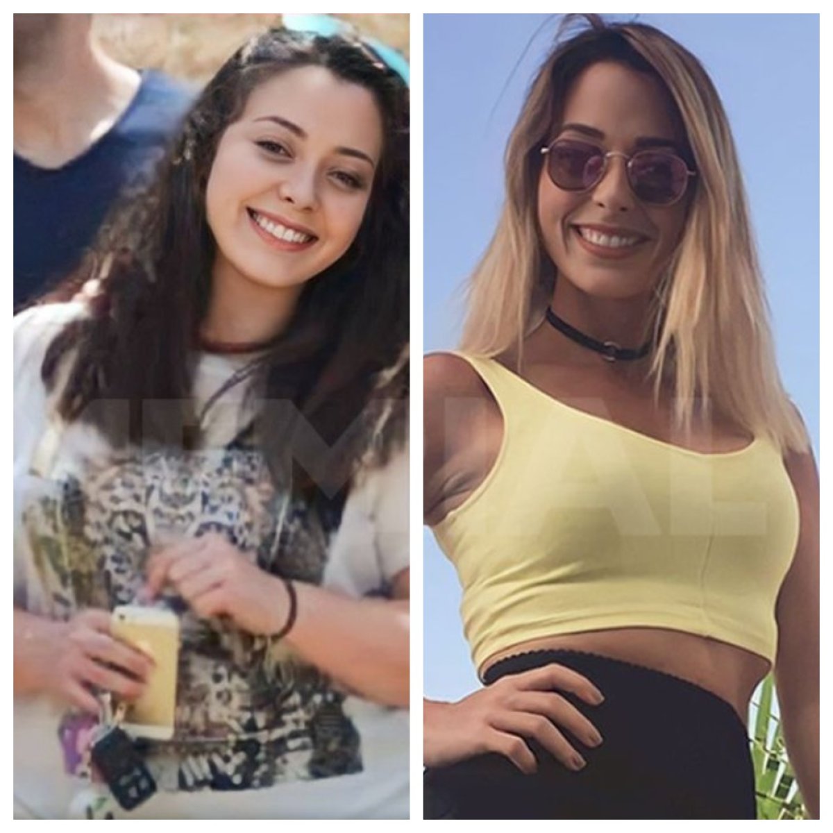 Before and after gastric bypass at Memorial Şişli Hospital, visible weight loss results