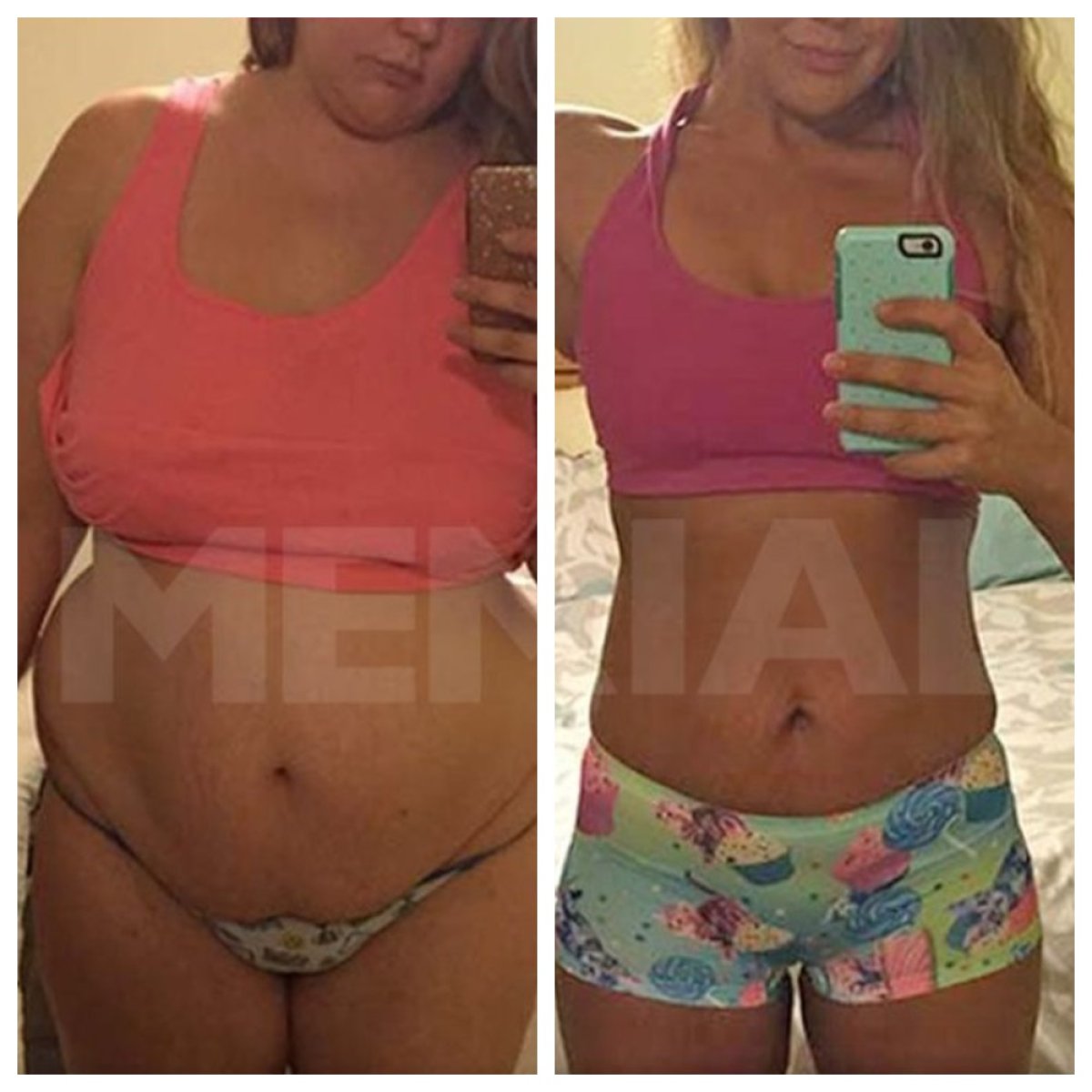Before and after gastric bypass at Memorial Şişli Hospital, visible weight loss results