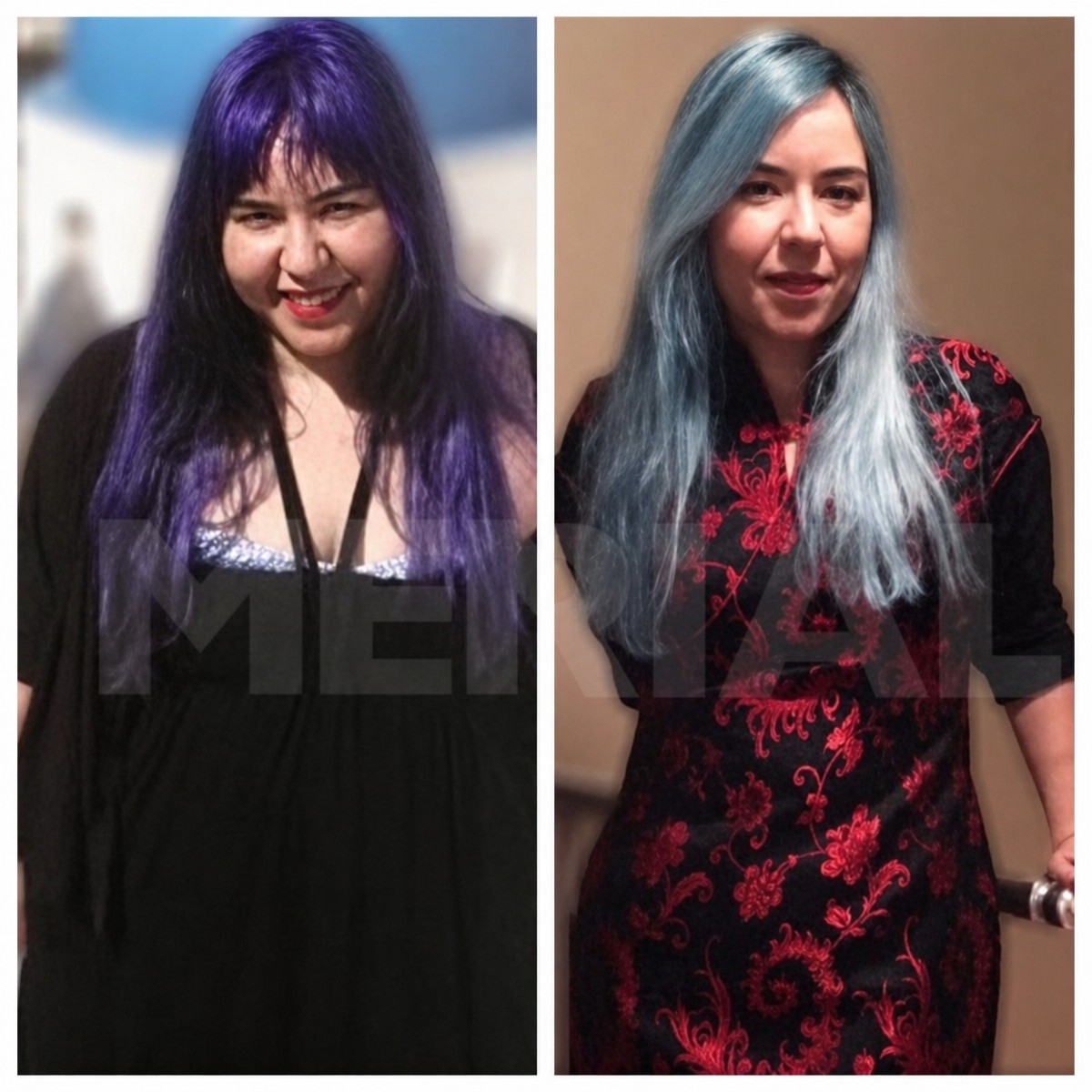 Before and after gastric bypass results at Memorial Şişli Hospital, significant weight loss shown