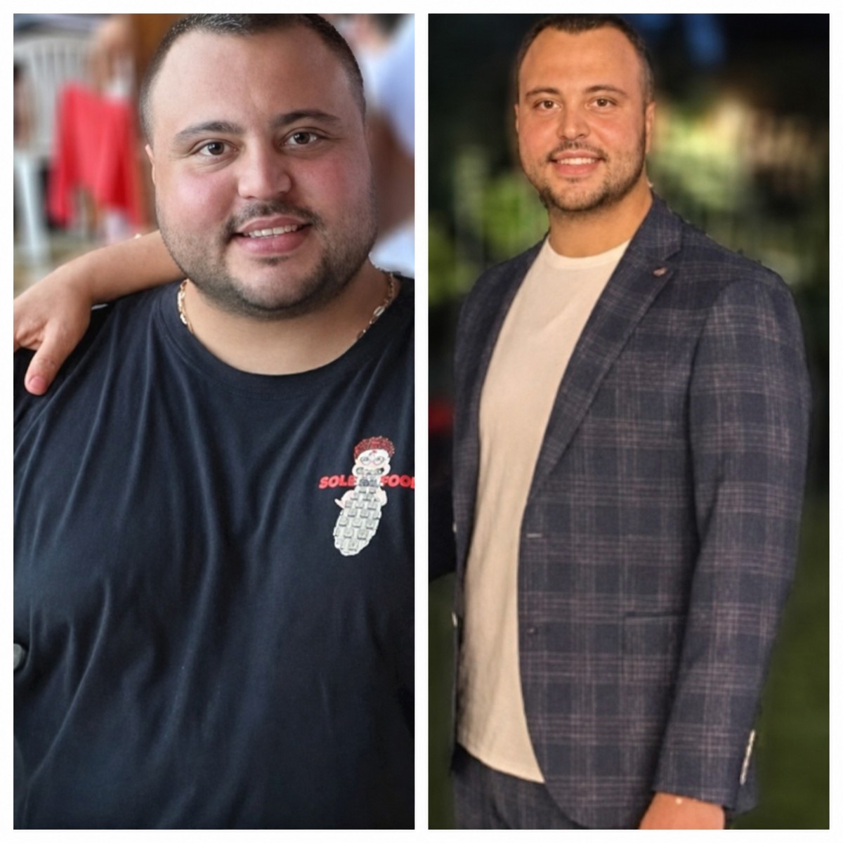 Before and after gastric bypass at Memorial Şişli Hospital – significant weight loss result