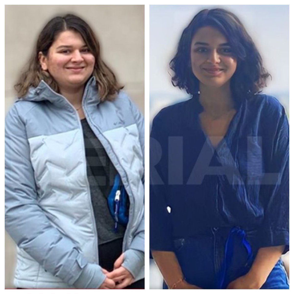 Before and after gastric bypass results at Memorial Şişli Hospital, visible weight loss