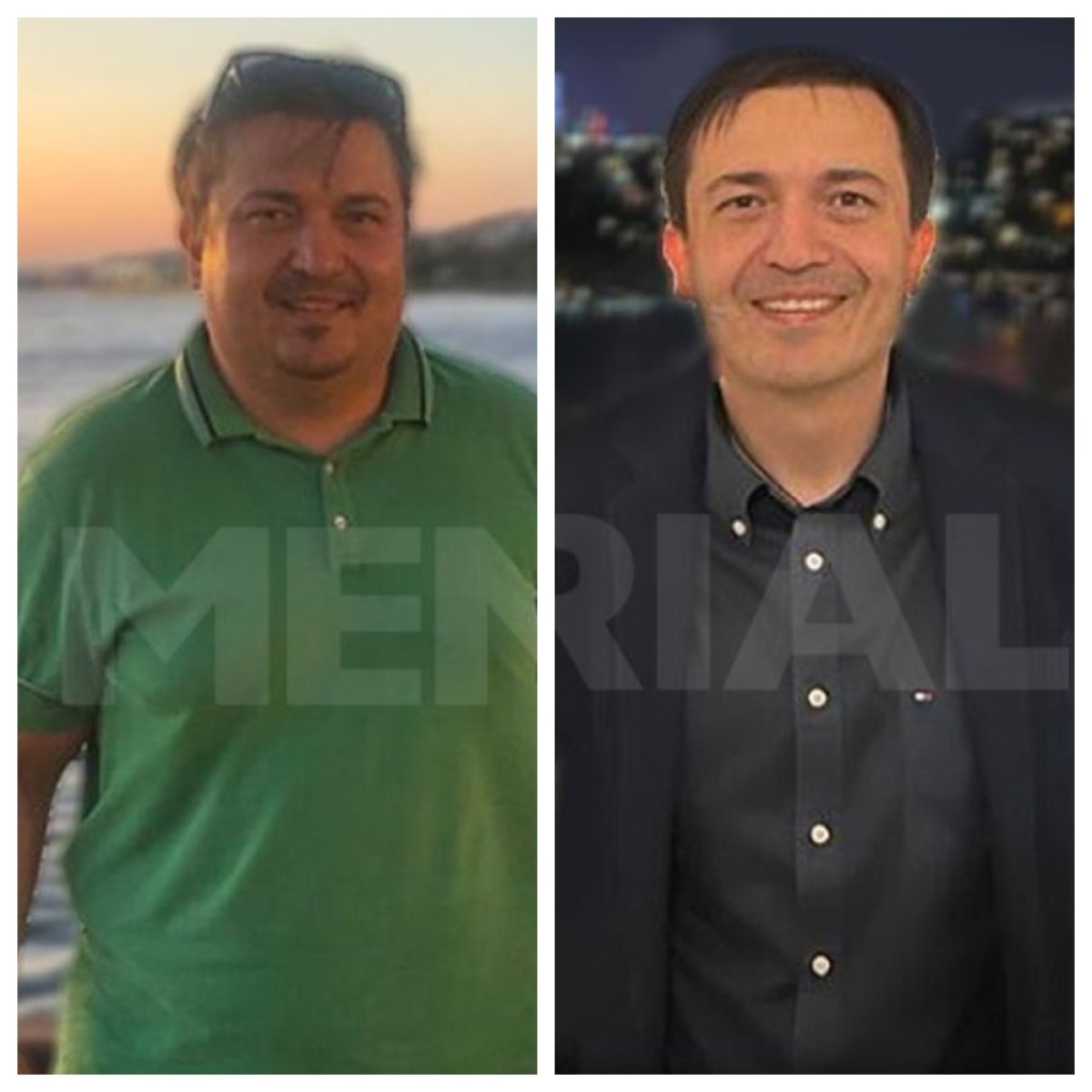 Before and after gastric bypass at Memorial Şişli Hospital, significant weight loss results