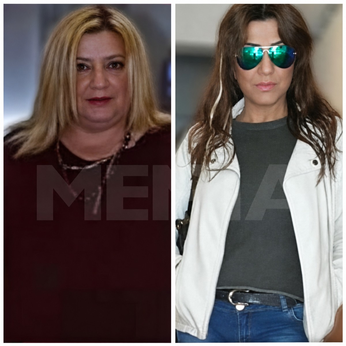 Gastric bypass before and after results at Memorial Şişli Hospital, significant weight loss