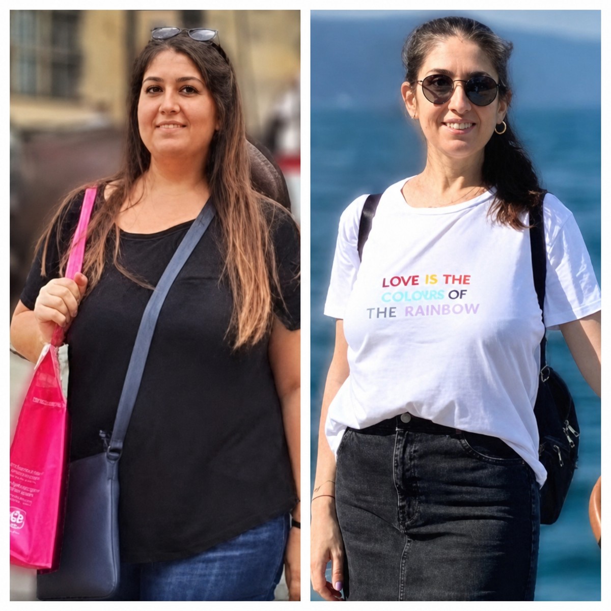 Before and after gastric bypass at Memorial Şişli Hospital – significant weight loss result
