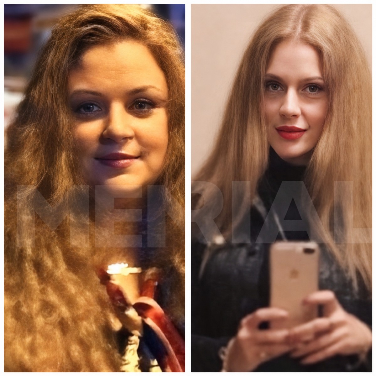 Before and after gastric bypass at Memorial Şişli Hospital – visible facial slimming result