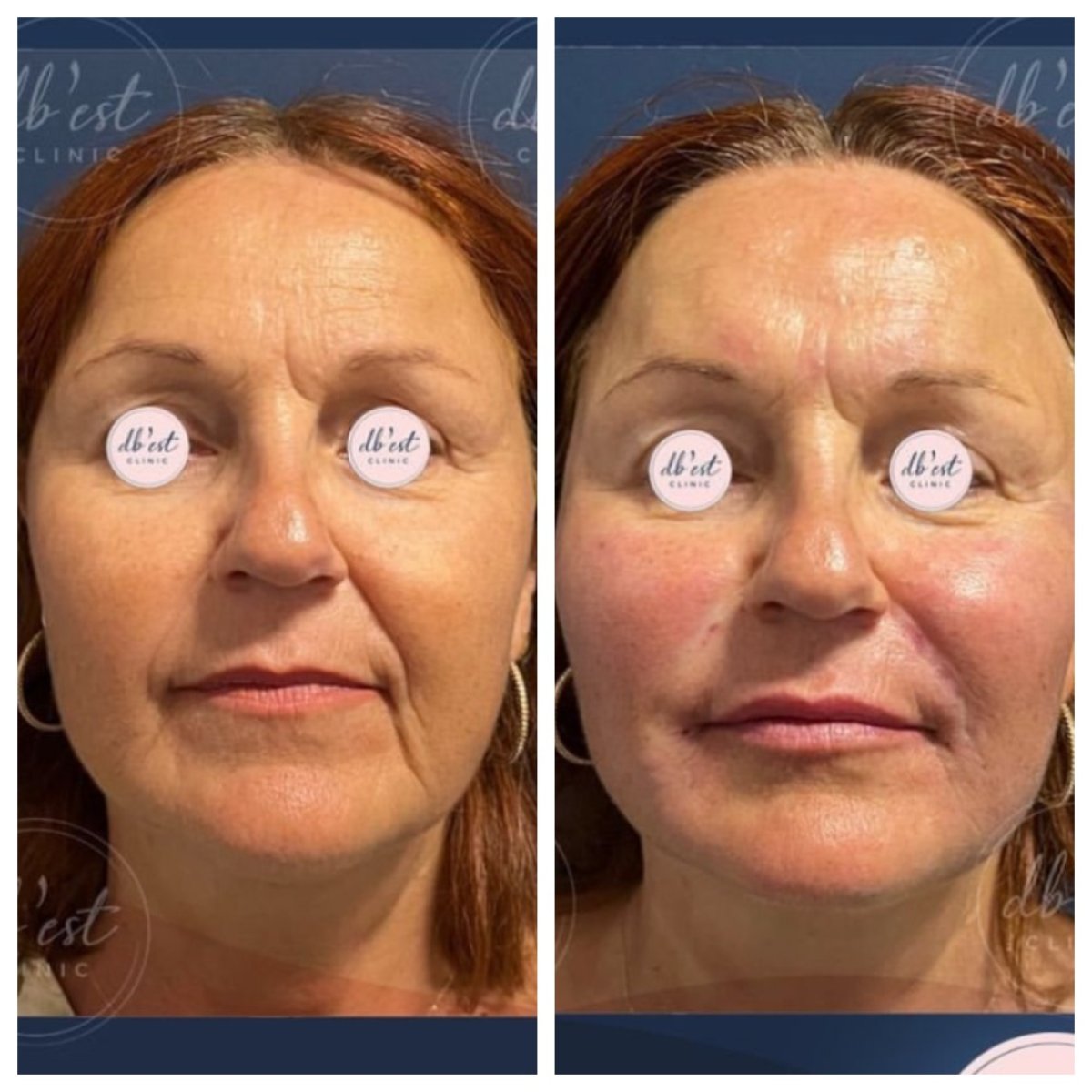 Resultados antes y después de rellenos en Db'est Clinic, rejuvenecimiento y restauración facial