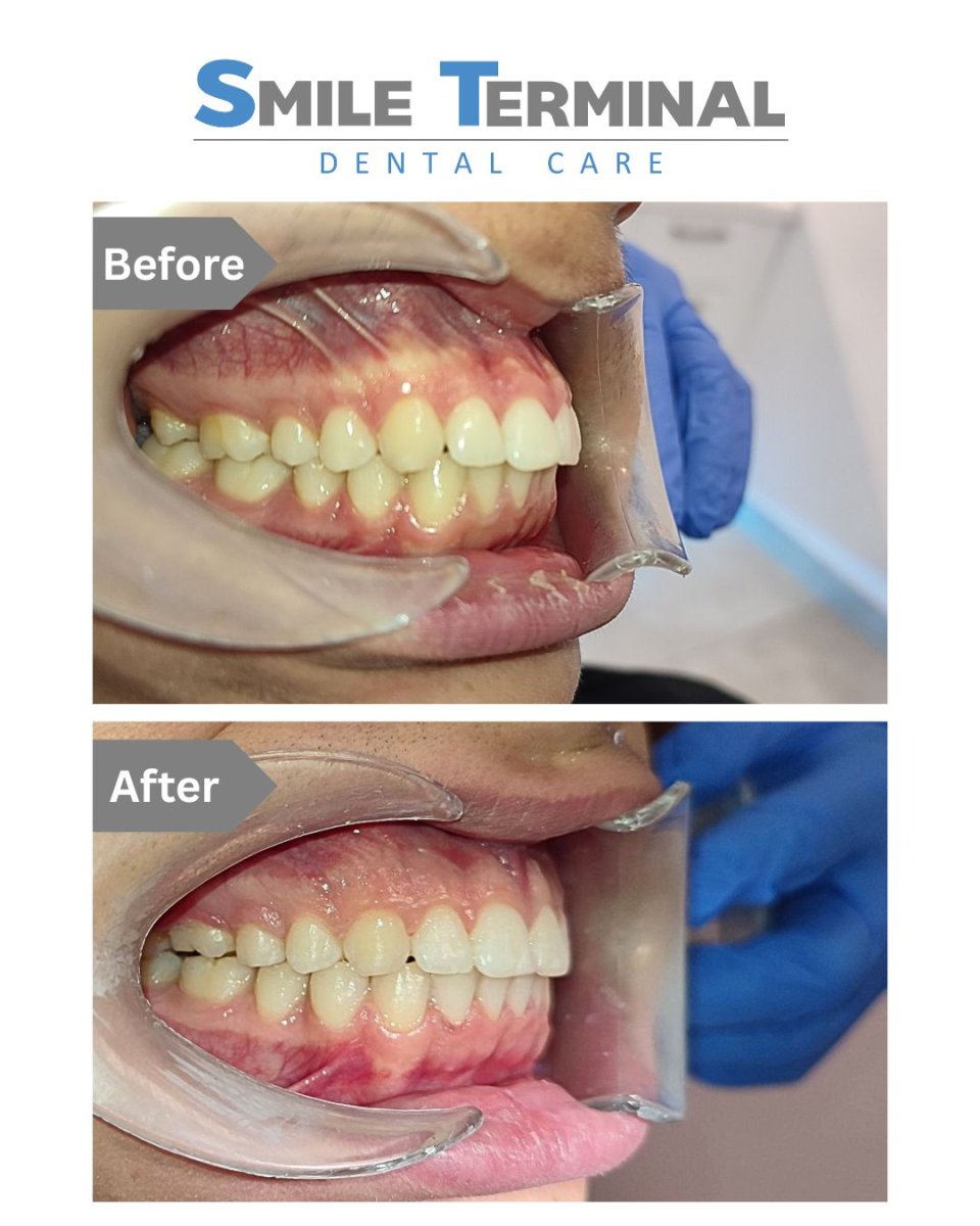 Antes y después de brackets para niños en Smile Terminal Dental Care, resultado de alineación