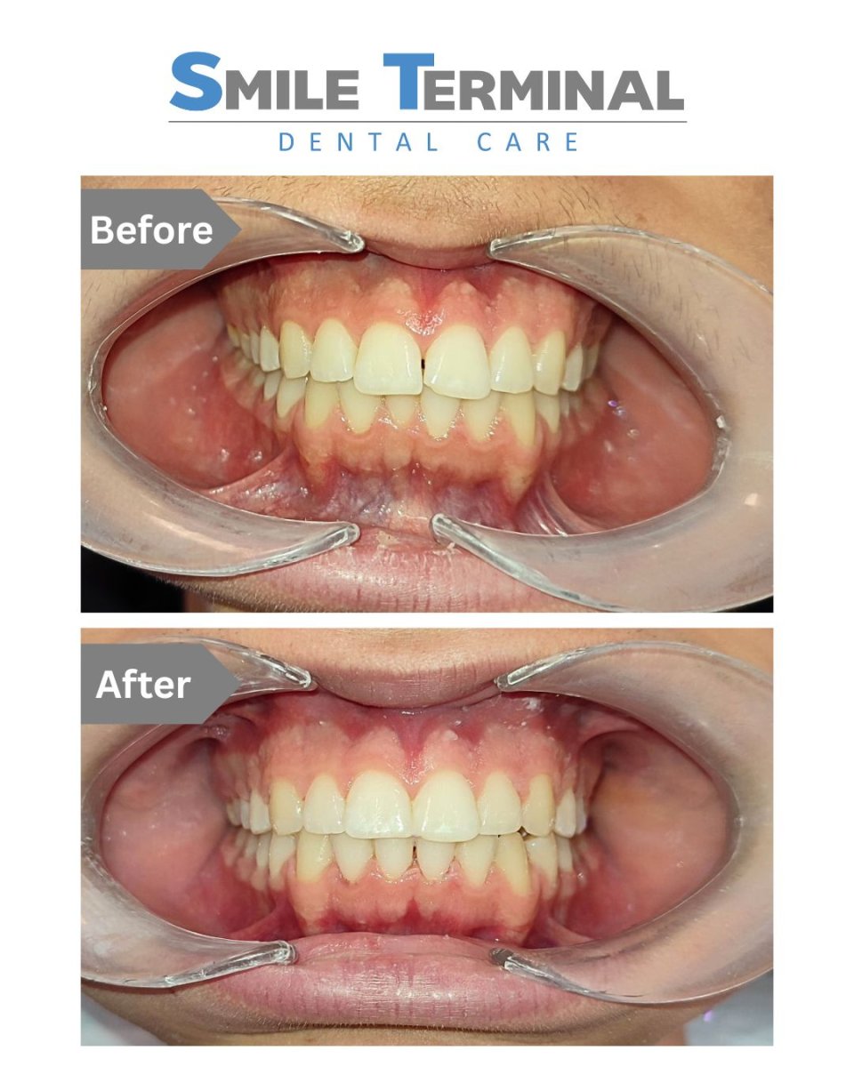 Résultats avant et après appareil dentaire enfant chez Smile Terminal Dental Care, alignement visible