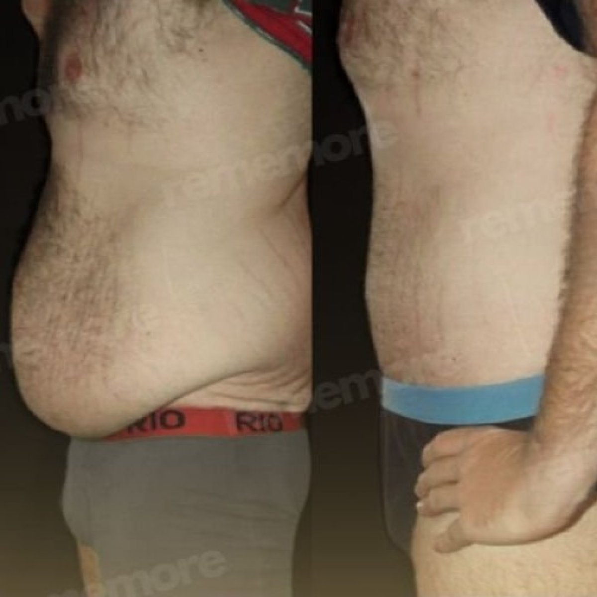 Before and after abdominal liposuction results at Memorial Şişli Hospital, improved body contour