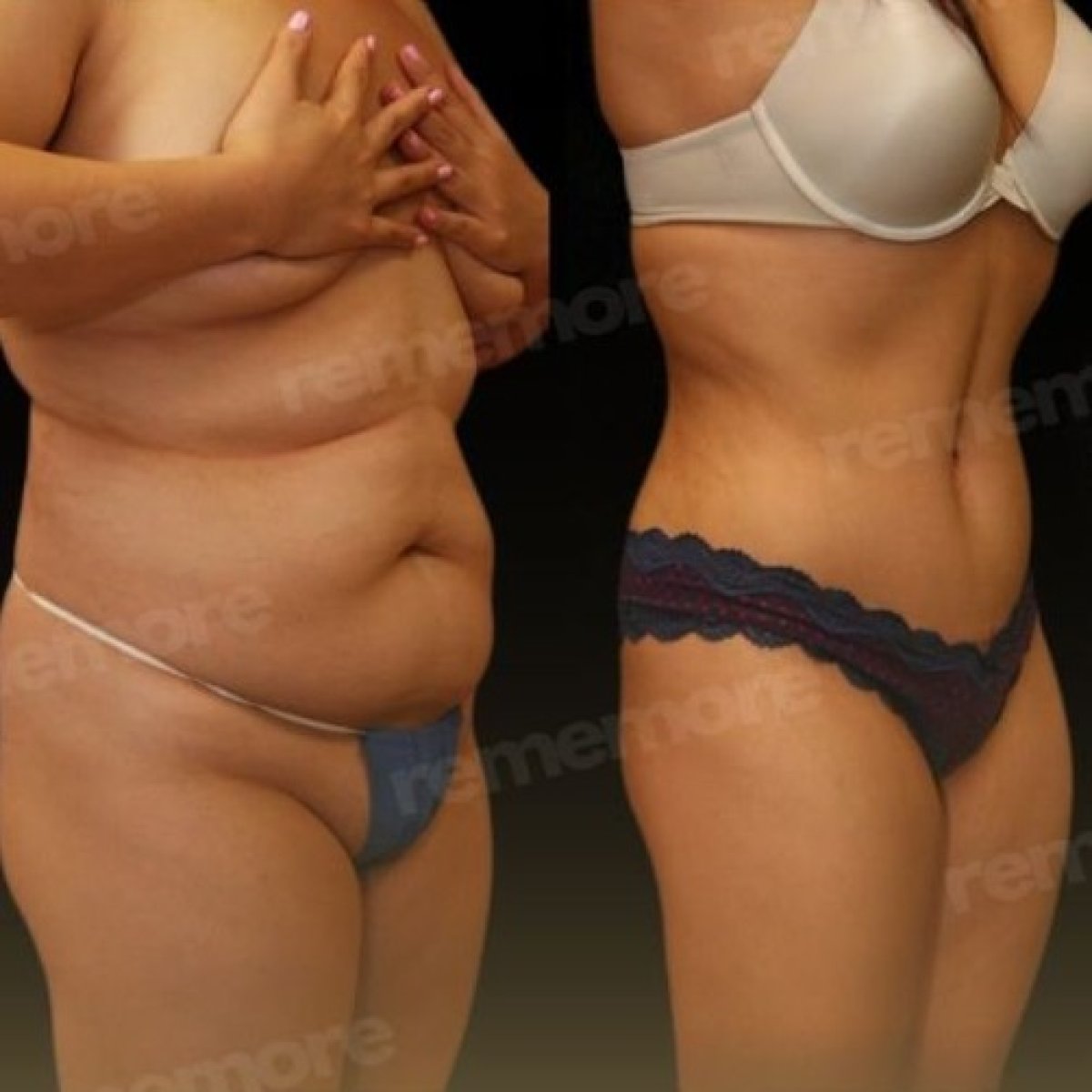 Resultados de liposucción abdominal antes y después en Memorial Şişli Hospital, cintura más delgada