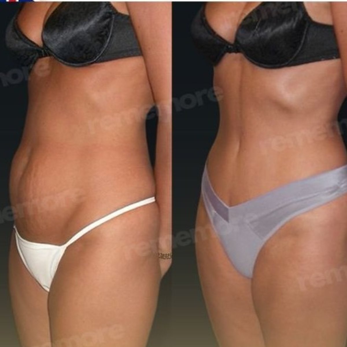 Resultados de liposucción abdominal antes y después en Memorial Şişli Hospital, cintura más delgada