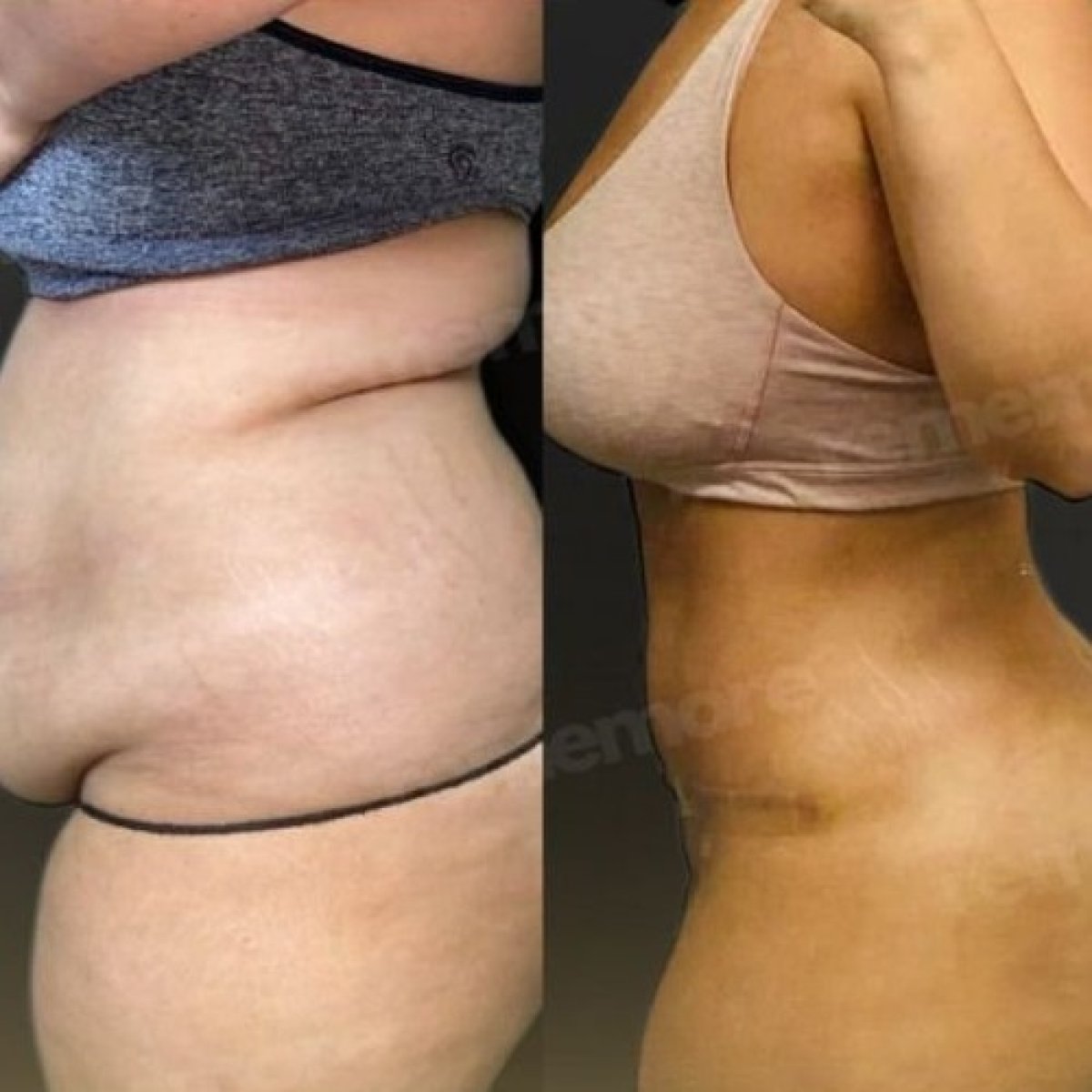Résultats avant et après liposuccion abdominale à Memorial Şişli Hospital, taille affinée