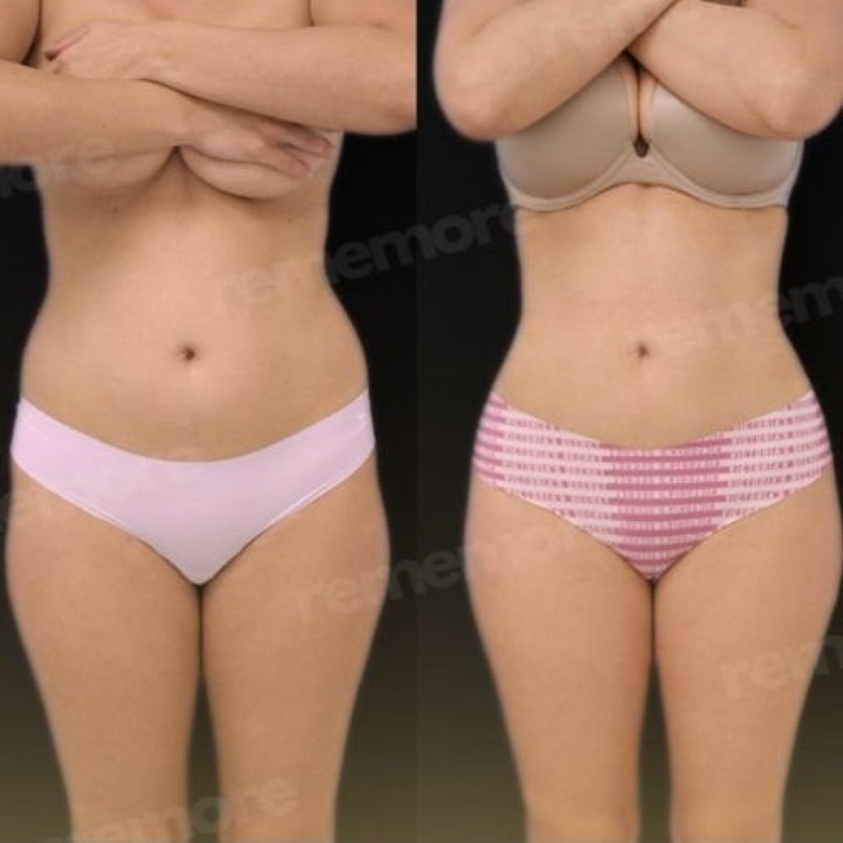 Before and after abdominal liposuction results at Memorial Şişli Hospital, slimmer waistline