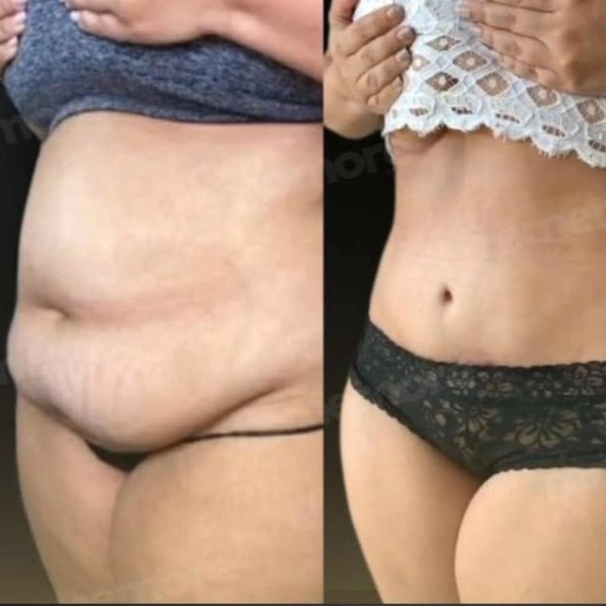 Résultats avant/après liposuccion abdominale à Memorial Şişli Hospital, taille affinée