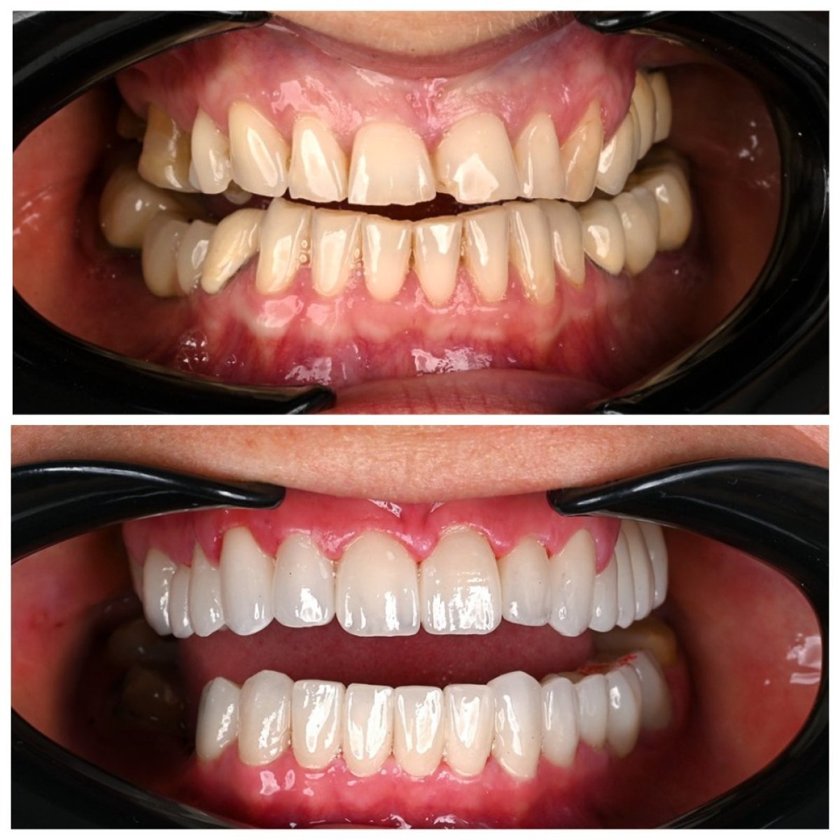 Antes y después de coronas dentales en Soraca Med, mejora de sonrisa y alineación dental