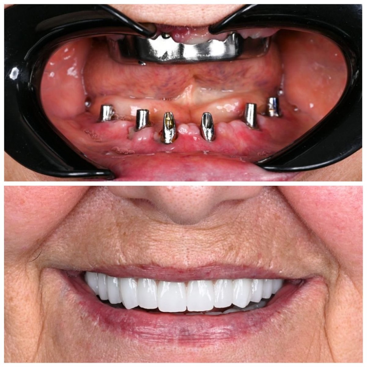 Before and after All-on-6 dental implants at Soraca Med, full smile restoration results