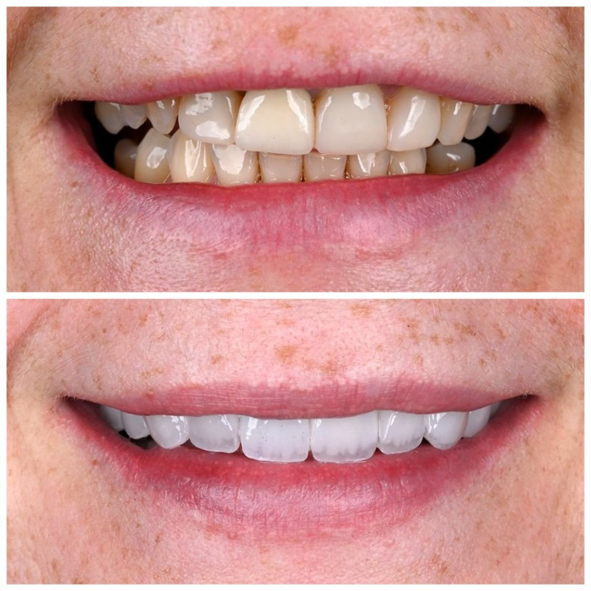 Before and after zirconia crown installation at Soraca Med – improved smile aesthetics result