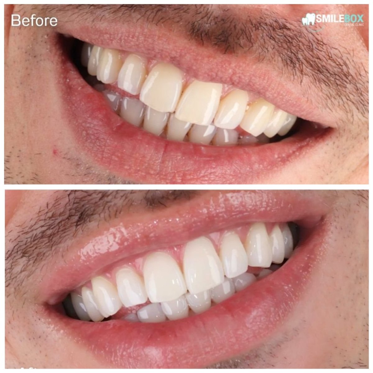 نتائج تبييض الأسنان قبل وبعد في SmileBox Dental Clinic - Thonglor, Sukhumvit Branch