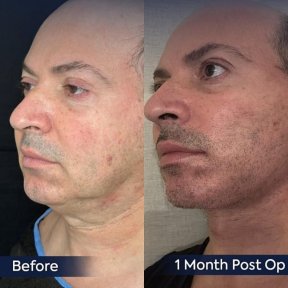 Premium Face&Neck lift + Upper Blephasroplasty+ Fat Transfer to Face Surgery -All Incluisive with European Board Certified Doctor Ali Sadioglu - photo 6