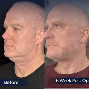 Premium Face&Neck lift + Upper Blephasroplasty+ Fat Transfer to Face Surgery -All Incluisive with European Board Certified Doctor Ali Sadioglu - photo 5