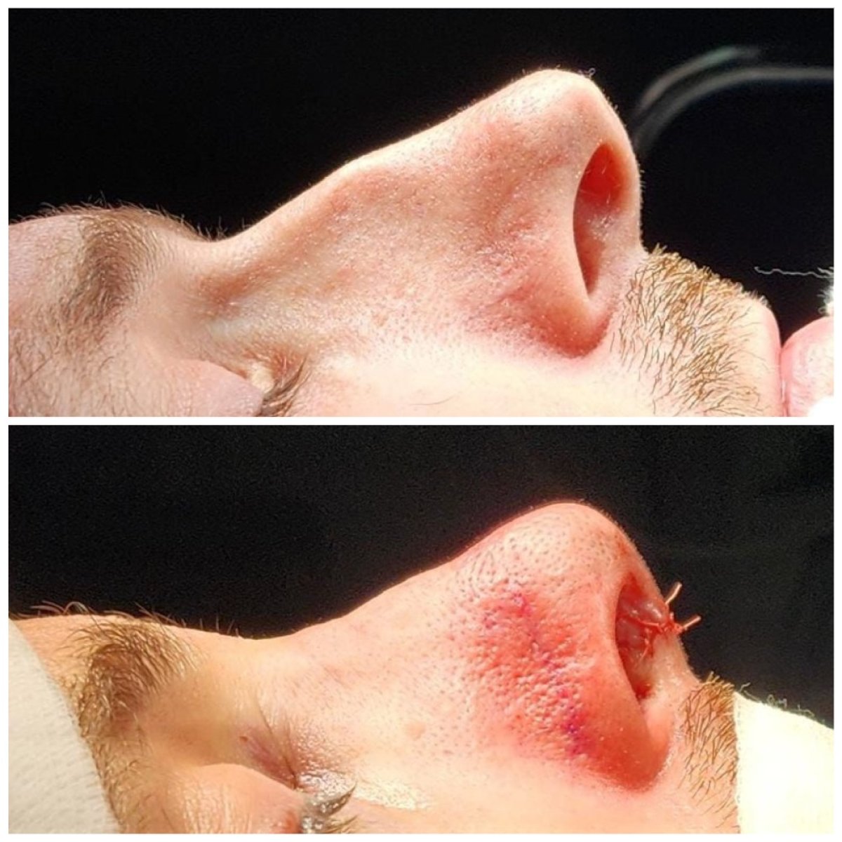 Resultado de rinoplastia antes y después en Risus Clinic Istanbul, remodelación visible de la nariz