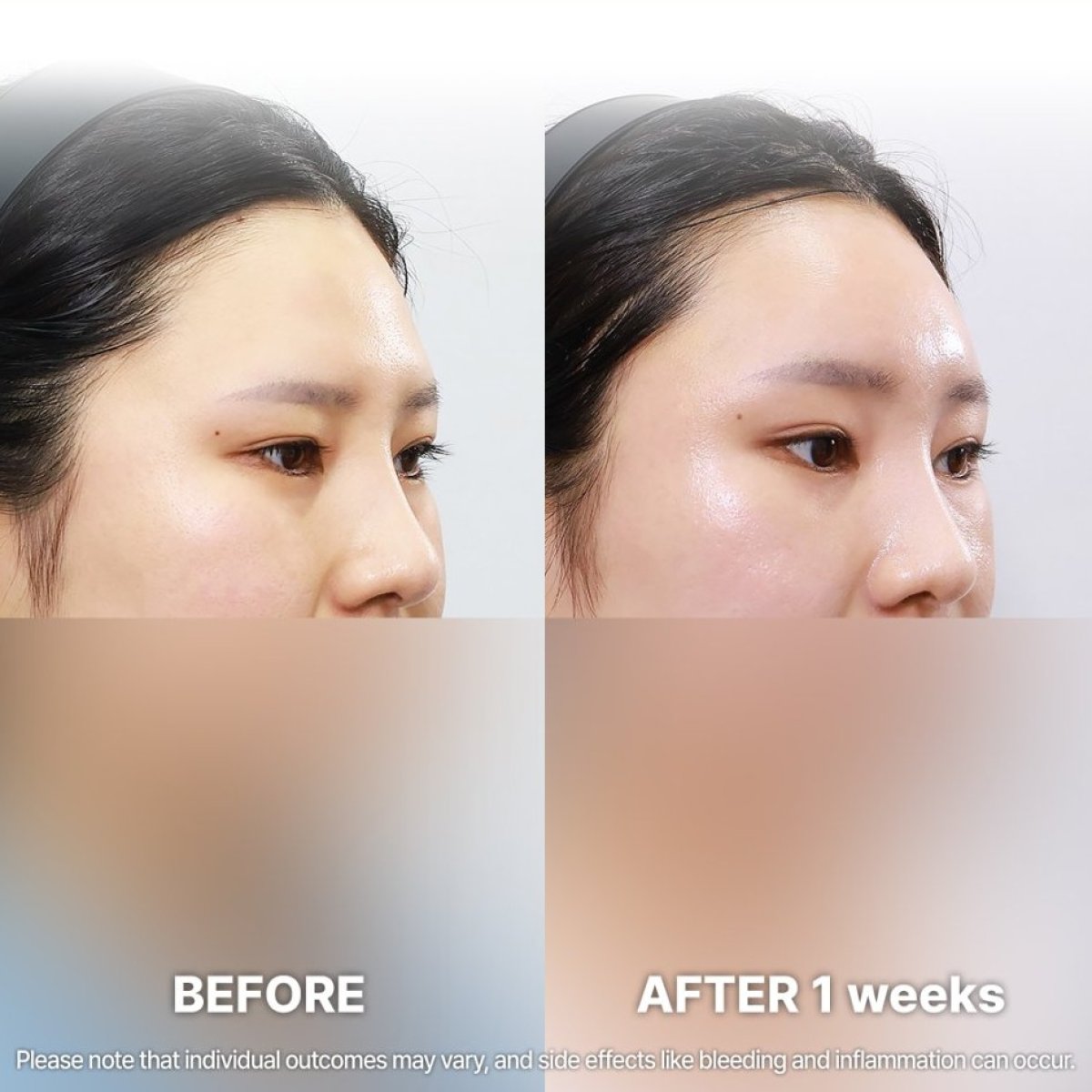Forehead lift before and after results at Returning Plastic Surgery, visible brow elevation