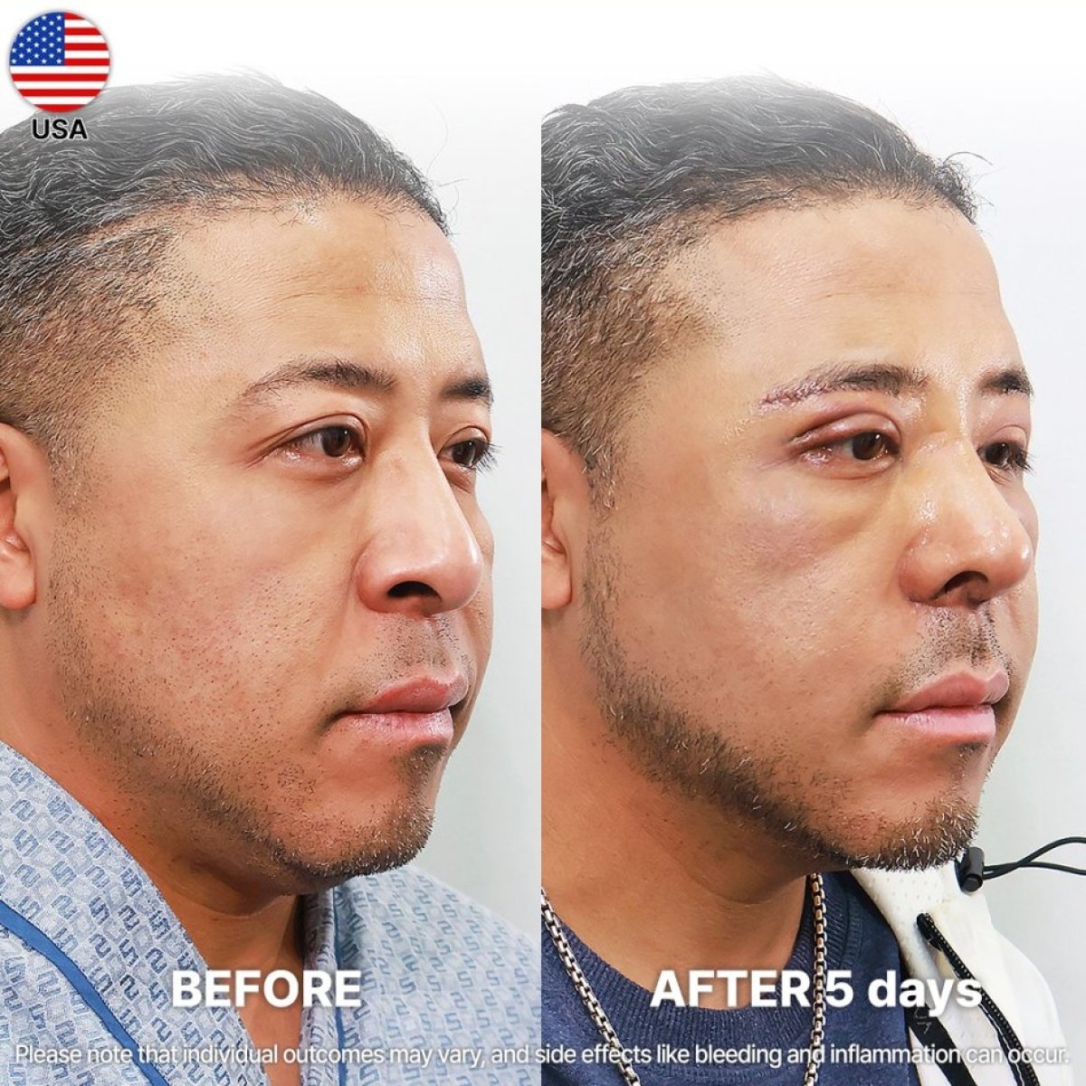 Before and after eyelid surgery results at Returning Plastic Surgery, visible improvement in 5 days