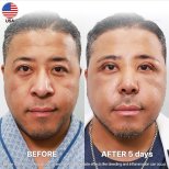 Rhinoplasty (nose job) results by Dr. Yong Woo Kim - Patient’s before and after images Before and after Rhinoplasty (nose job) photos by Dr. Yong Woo Kim