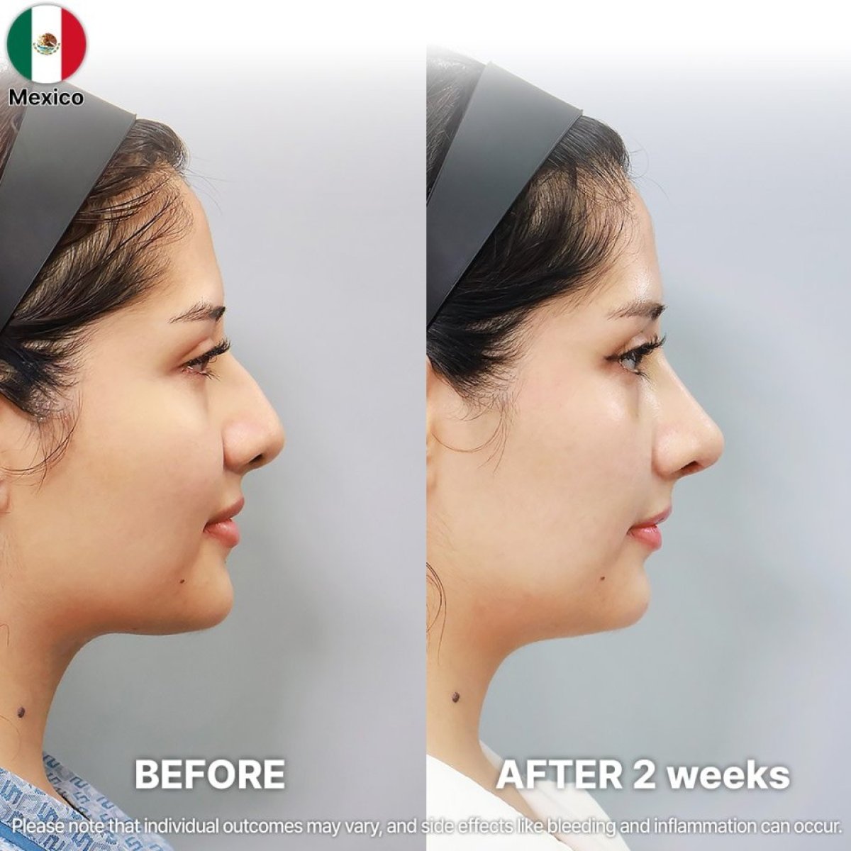 Before and after rhinoplasty results at Returning Plastic Surgery, nose reshaping after 2 weeks