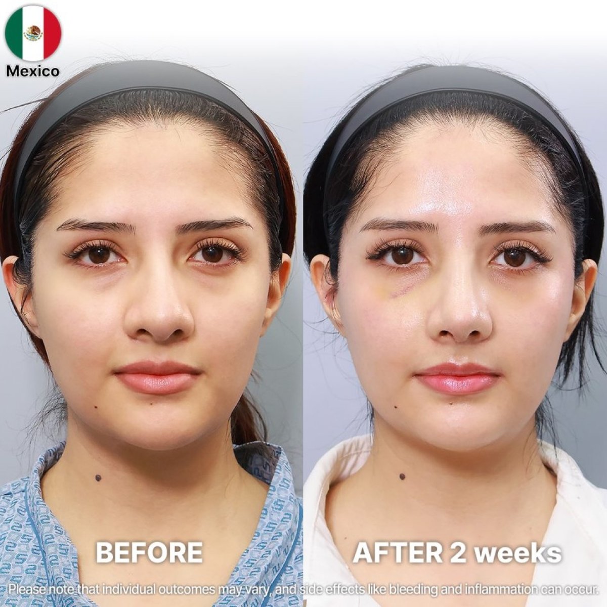 Before and after rhinoplasty results at Returning Plastic Surgery, nose reshaping in Mexico