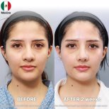 Rhinoplasty (nose job) results by Dr. Yong Woo Kim - Patient’s before and after images Before and after Rhinoplasty (nose job) photos by Dr. Yong Woo Kim