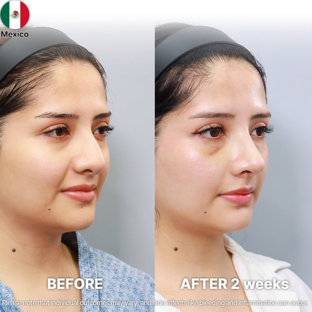 Результаты ринопластики до и после в Returning Plastic Surgery, коррекция носа через 2 недели