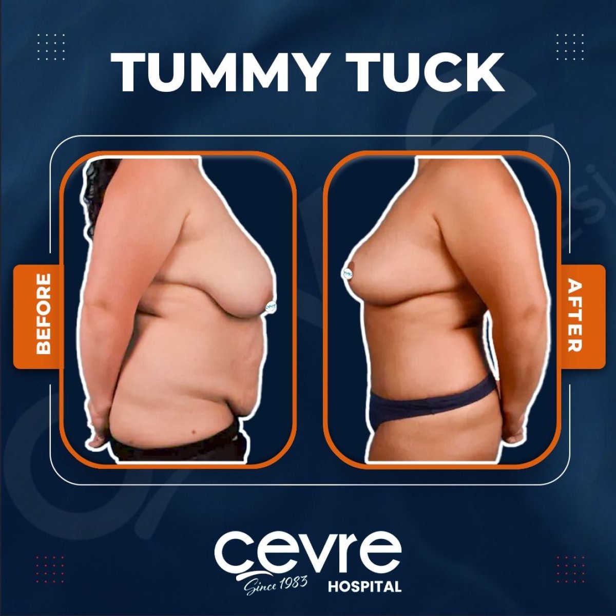 Resultados de abdominoplastia antes y después en Adem and Havva Medical Center – abdomen plano