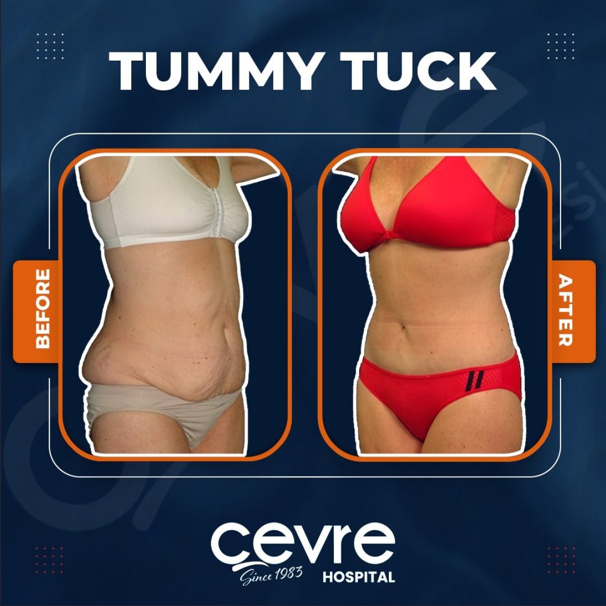 Résultats avant et après abdominoplastie à Cevre Hospital, amélioration du ventre